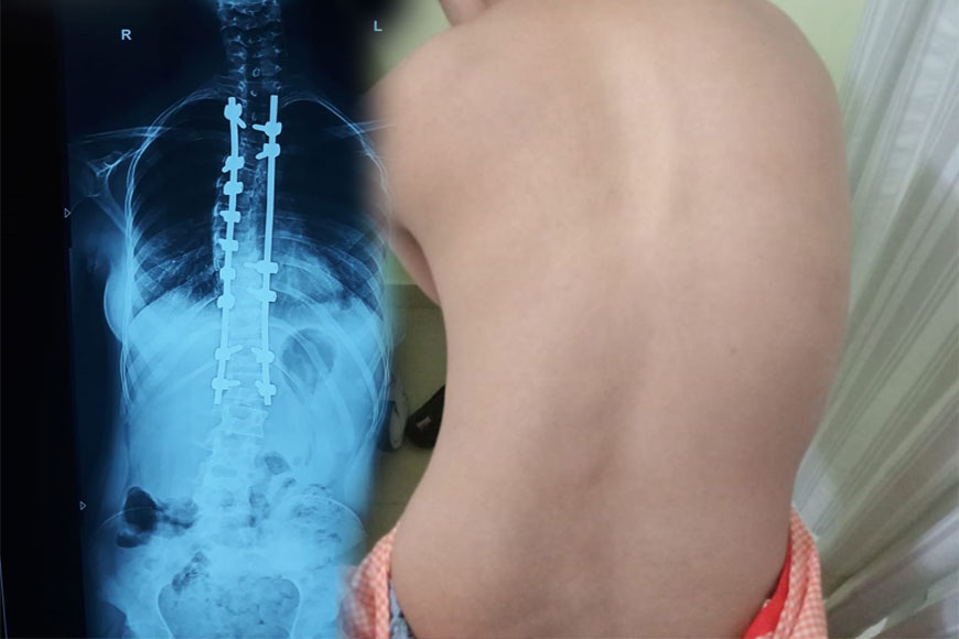 &nbsp;Institute of Neurosciences sets milestone! Rare operation on Scoliosis patient&nbsp;
