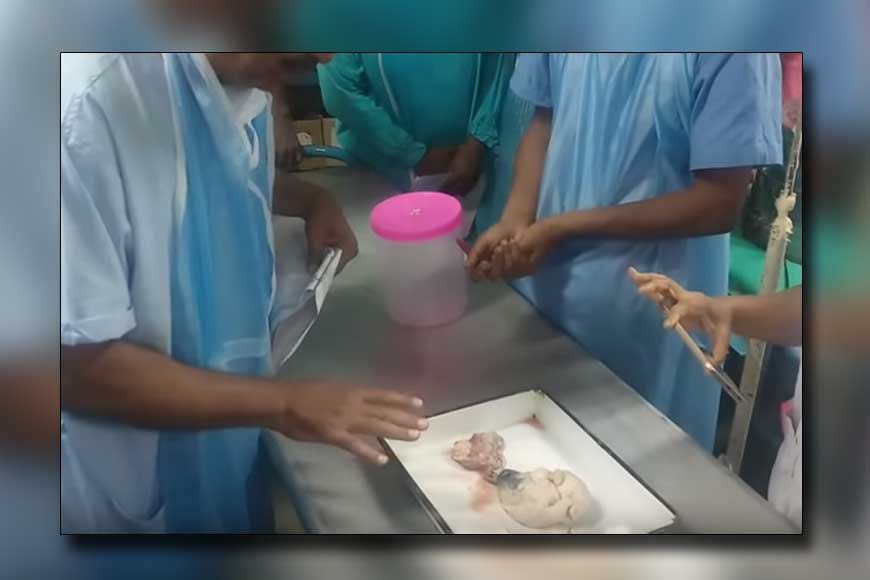 Burdwan Medical College doctors perform miracle operation
